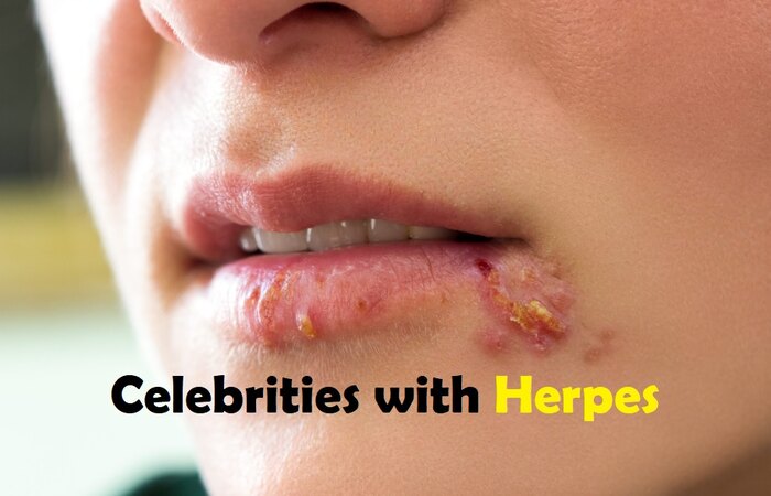 Top 5 Famous Celebrities with Herpes Top 5 Famous Celebrities with Herpes
